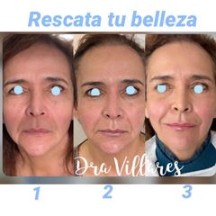Ácido hialurónico - Doctora Villares
