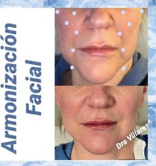 Armonización facial - Doctora Villares