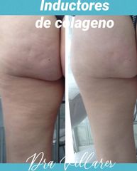 Celulitis - Doctora Villares