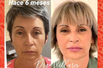 Rejuvenecimiento facial - Doctora Villares