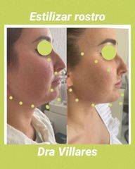 Ácido hialurónico - Doctora Villares