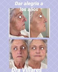 Rellenos faciales - Doctora Villares
