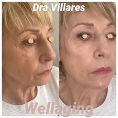 Hilos tensores - Doctora Villares