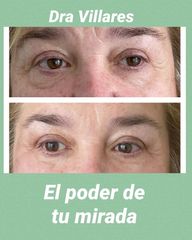 Eliminación de ojeras - Doctora Villares
