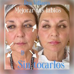 Aumento de labios - Doctora Villares