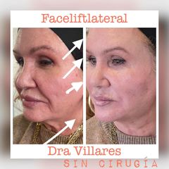 Rejuvenecimiento facial - Doctora Villares