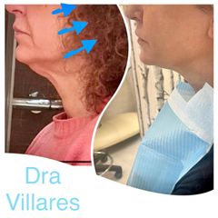 Lifting sin cirujia - Doctora Villares