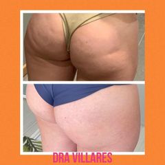 Mesoterapia - Doctora Villares