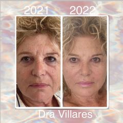Hilos tensores - Doctora Villares