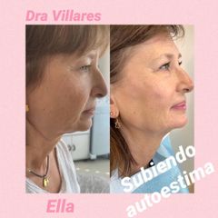 Lifting sin cirugía - Doctora Villares
