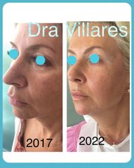 Lifting sin cirugía - Doctora Villares