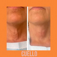 Lifting sin cirugía - Doctora Villares