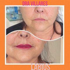 Aumento de labios - Doctora Villares