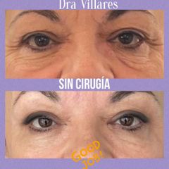 Eliminación de arrugas - Doctora Villares