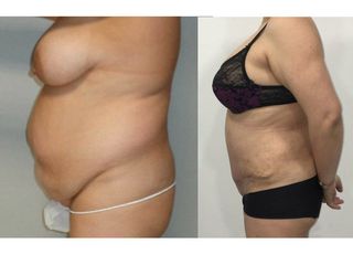 Antes y después abdominoplastia