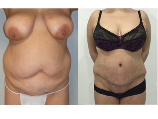 Antes y después abdominoplastia1
