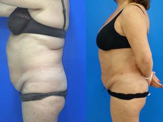 Antes y después lipoescultura