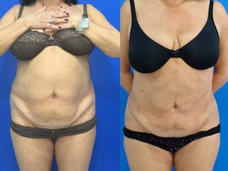 Antes y después lipoescultura