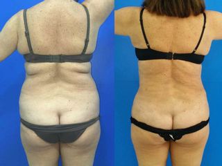 Antes y después lipoescultura