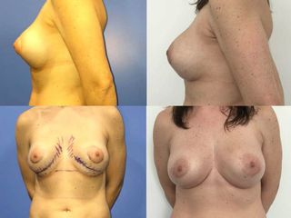 lipofilling-mamario-doble-burbuja