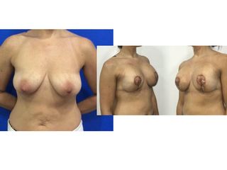Antes y después mastopexia 