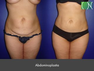 Antes y después Abdominoplastia