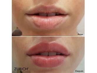 Aumento labios - 634754