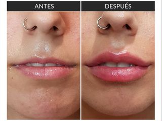 Antes y Después aumento de labios