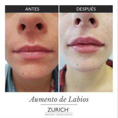 Antes y después aumento de labios 