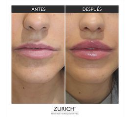 Antes y después aumento de labios 