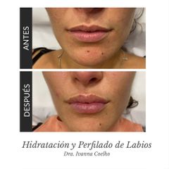 Aumento de labios - Clínicas Zurich
