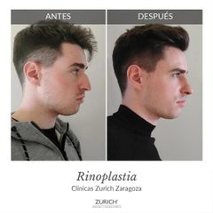 Rinoplastia - Clínicas Zurich