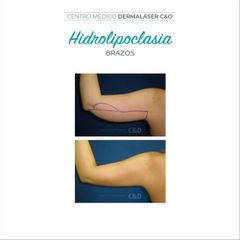 Hidrolipoclasia - Dermaláser C&O