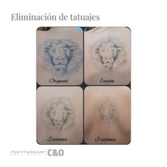 Eliminación de tatuajes - Dermaláser C&O