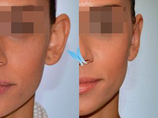 Antes y después Cirugía de orejas