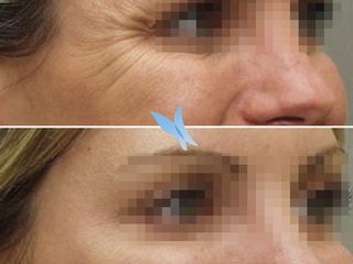 Antes y después Eliminar arrugas con Botox