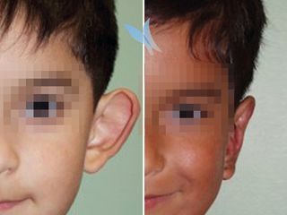 Antes y después Otoplastia en niños