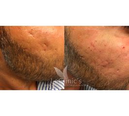 Antes y después Dermapen