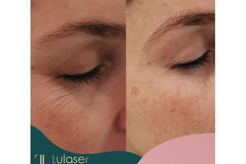 Radiofrecuencia facial antes y después - 648065