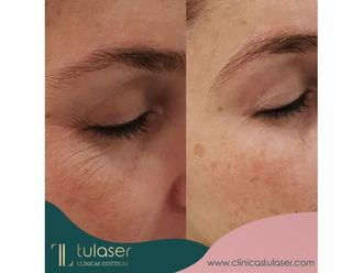 Radiofrecuencia facial - 648065