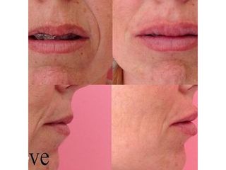 Rejuvenecimiento de labios con ácido hialurónico - Clínica Gove