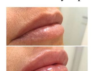 Aumento labios - 820680