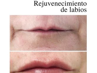 Aumento labios - 820682