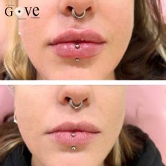 Aumento de labios - Clínica Gove