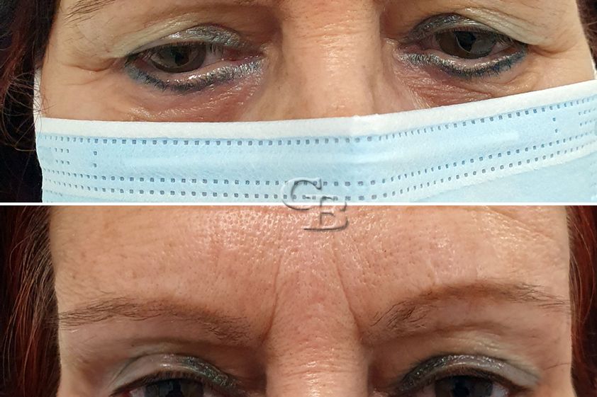 Blefaroplastia sin cirugía antes y después - 738790
