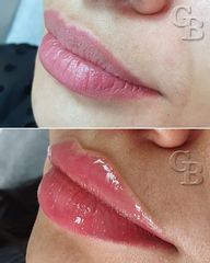 Aumento de labios - Dr. George Beridze