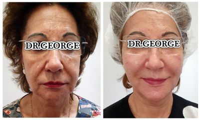 Rejuvenecimiento facial - Dr. George Beridze