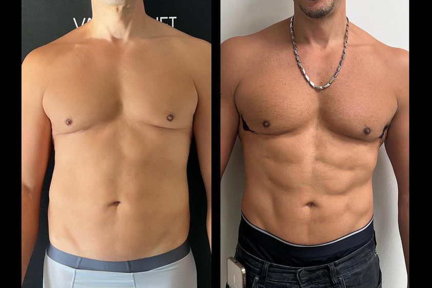 Marcación abdominal antes y después - 849226