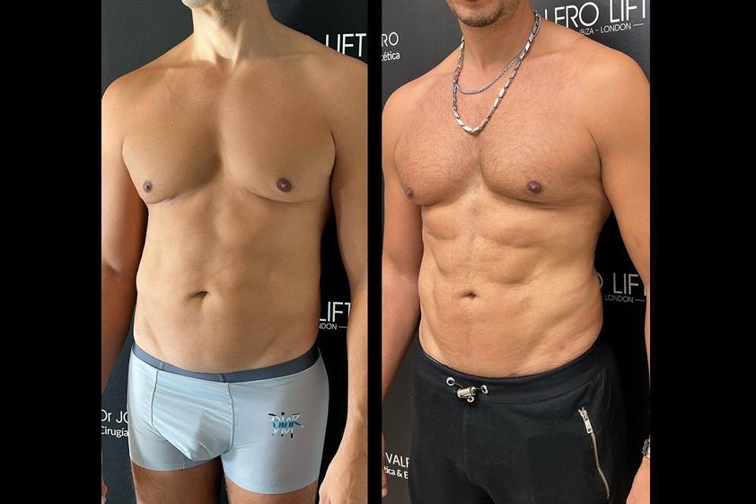 Marcación abdominal antes y después - 849237