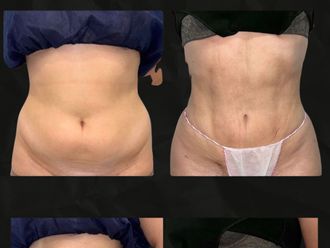 Liposucción antes y después - 879882